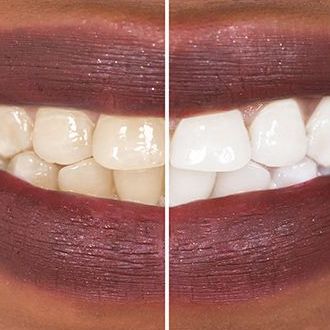 Teeth Whitening