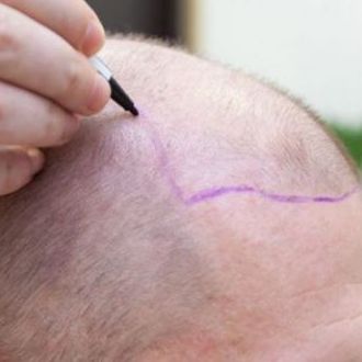 Best Hair Restoration