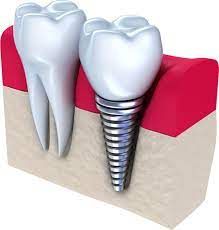 At Alabama Periodontics, we specialize in dental implant placement, cosmetic gum contouring, treatment of periodontal disease, receding gums, the diagnosis and treatment of oral pathologies, and preventative cleanings. We utilize the latest technology, including dynamic 3D navigation and laser-assisted surgeries to maximize the quickest healing times and best results for our patients.  https://www.alabamaperiodontics.com/dental-implants-teeth-in-a-day/