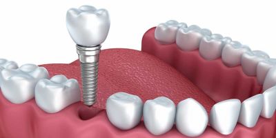 At Alabama Periodontics, we specialize in dental implant placement, cosmetic gum contouring, treatment of periodontal disease, receding gums, the diagnosis and treatment of oral pathologies, and preventative cleanings. We utilize the latest technology, including dynamic 3D navigation and laser-assisted surgeries to maximize the quickest healing times and best results for our patients. https://www.alabamaperiodontics.com/dental-implants-teeth-in-a-day/