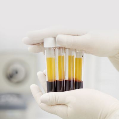 factores de crecimiento o plasma rico en plaquetas ayuda en tu implante de cabello hhttps://scatter.ec/ 
https://sonriefeliz.com/