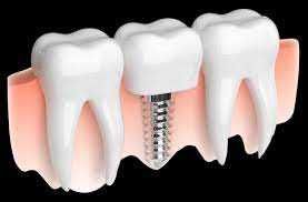 At Alabama Periodontics, we specialize in dental implant placement, cosmetic gum contouring, treatment of periodontal disease, receding gums, the diagnosis and treatment of oral pathologies, and preventative cleanings. We utilize the latest technology, including dynamic 3D navigation and laser-assisted surgeries to maximize the quickest healing times and best results for our patients. https://www.alabamaperiodontics.com/gum-grafting-birmingham-periodontist/